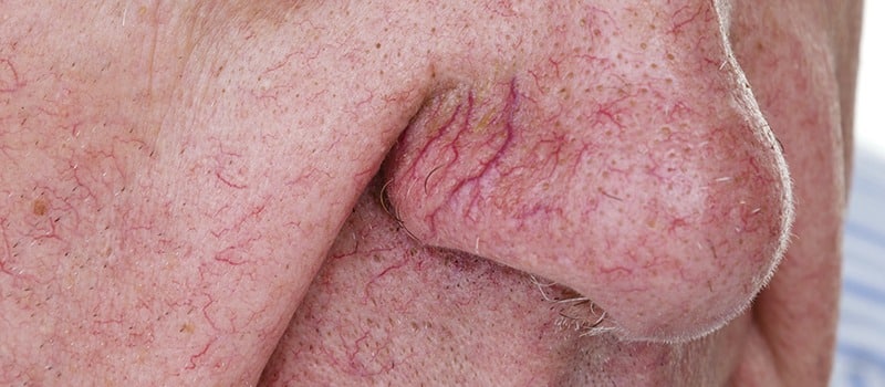 Used to show Vascular Lesions on the face at Gitter Vein