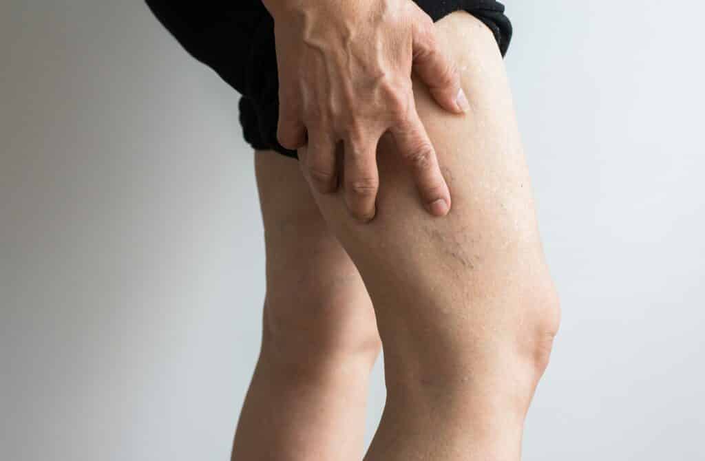 Varicose veins on the elderly asian woman leg,Close up